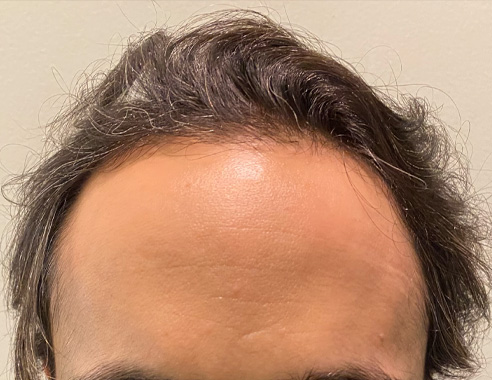 hair loss treatment before